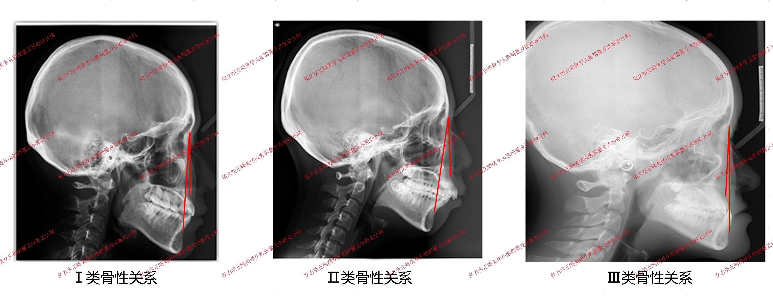 宫剑教授病例分享（三十）：婴幼儿颅缝早闭的手术治疗 - 脑医汇 - 神外资讯 - 神介资讯